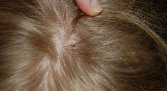 Luizen discrimineren niet