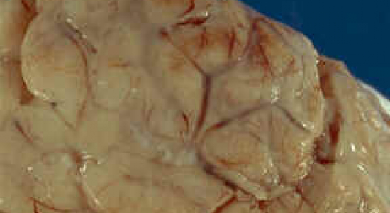 Alles over hersenvliesontsteking (nekkramp)