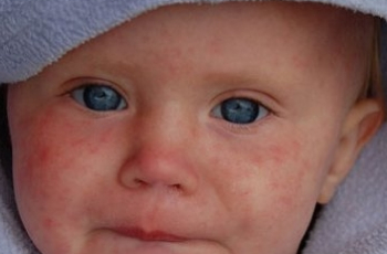 Bijna-drama door mazelen