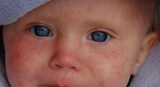 Bijna-drama door mazelen