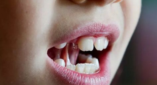 Kindertaal | Gratis taal- en spraakadviezen