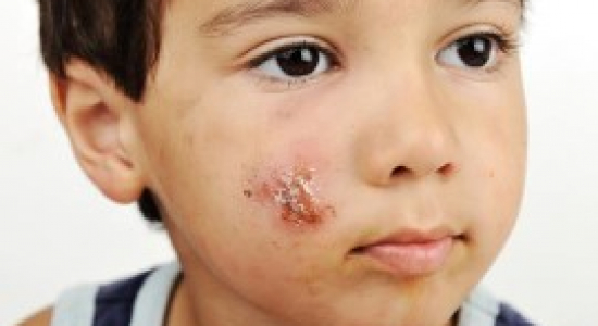 Krentenbaard bij kinderen