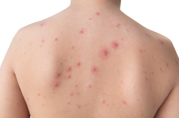 Waterpokken, wat is het en wat kun je ertegen doen