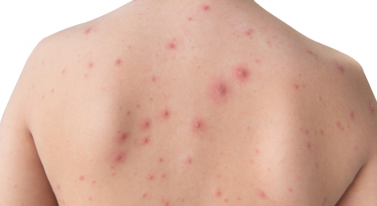 Waterpokken, wat is het en wat kun je ertegen doen