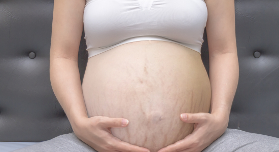 6 tips om striae tijdens je zwangerschap te voorkomen