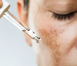 Pigmentvlekken tijdens de zwangerschap: wat kun je tegen een zwangerschapsmasker doen?