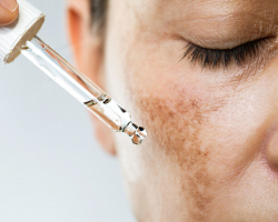 Pigmentvlekken tijdens de zwangerschap: wat kun je tegen een zwangerschapsmasker doen?