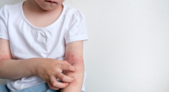 De beste kleding voor kinderen met eczeem: wat werkt en wat niet?
