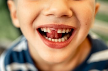 Is je kind rond de 8 jaar en nog geen melktand kwijt? Dit wil je weten over tanden wisselen